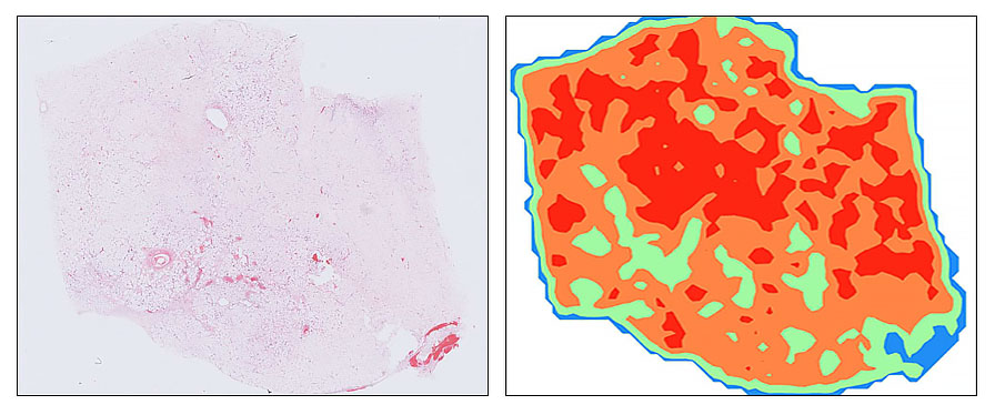 Atypical lipomatous tumour and its deep learning inference.