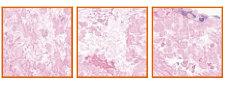 Three representative haematoxylin and eosin tiles from a model-derived neuroblastoma phenotype.